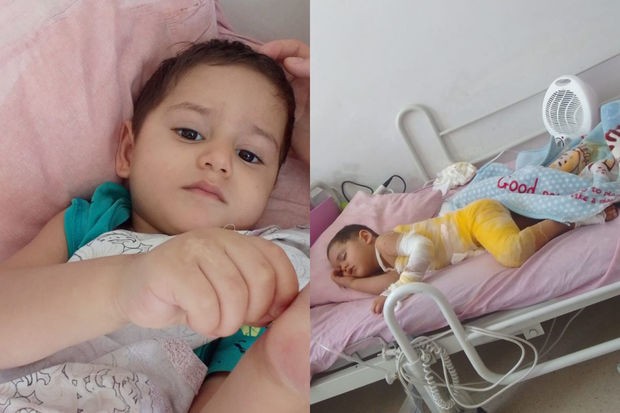 İki yaşlı Asimin dəstəyə ehtiyacı var: Ağır yanıq xəsarətləri alıb - FOTO