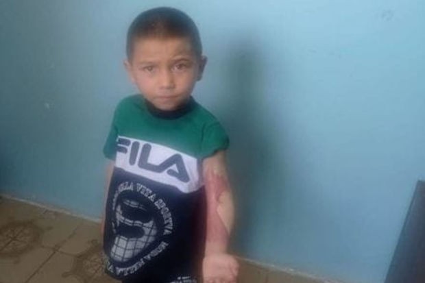 Qaynar suda yanan Ayxan köməyə möhtacdır: Atası iş qabiliyyətini itirib, anasının ayağını bel yarıb - FOTO