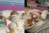 Ağır yanıq xəsarətləri alan bir yaşlı Mirzağanın yardımınıza ehtiyacı var - FOTO