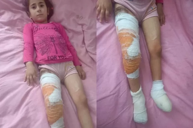 Altı yaşlı Kübra ağır yanıq xəsarətləri alıb: 